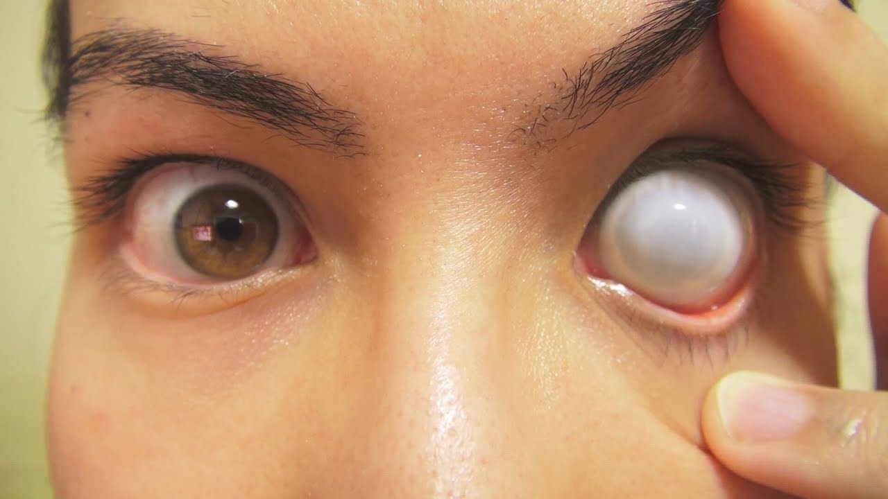Things to know about contact lenses